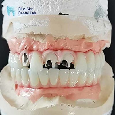 Beli Titanium Malo Bridge Implant Bridge Tanpa Multi Unit Abutment Cementable online manufacture