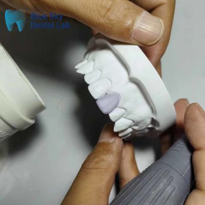 Beli 0.3mm Thin Glass Ceramic Veneer Implants Kasus Veneer Ringan online manufacture