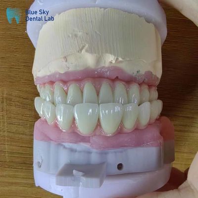 Beli Implan Gigi Lengkap Arka Buatan Kasus Operasi Untuk Prosedur Bedah online manufacture