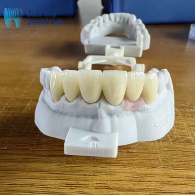 Beli Mahkota Zirconia Berlapis Sangat Transparan Alam Dengan Mahkota Implan online manufacture