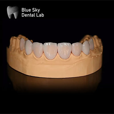 Beli Kasus veneer gigi persegi panjang ringan dengan passive fitting hanya 0,3mm online manufacture