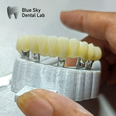Beli Kasus Implantasi Jembatan PMMA Untuk Skenario Implantasi Permukaan Langsing online manufacture