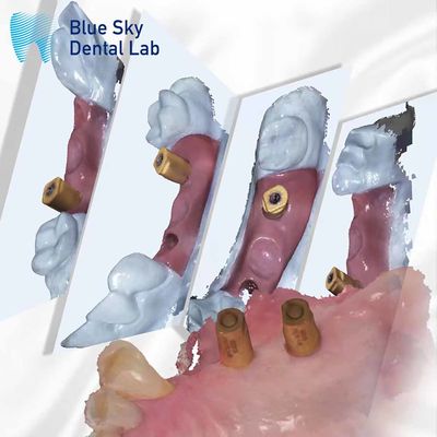 Beli Scan Badan Semua dalam Satu Kapsul Penyembuhan Gigi Blue Sky Sistem Implantasi online manufacture