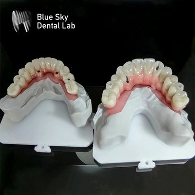 Beli Blue Sky Implant Full Arch Implant Case Alam Implant Case online manufacture
