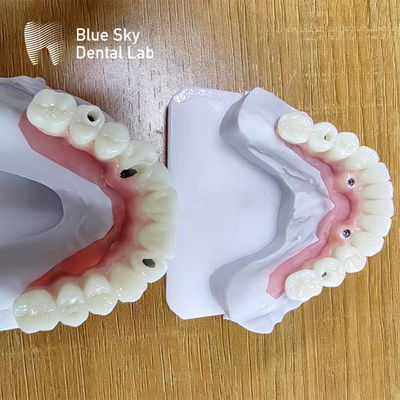 Beli Kasus Implantasi Multi Gigi Kasus Prosedur Implantasi Disesuaikan online manufacture
