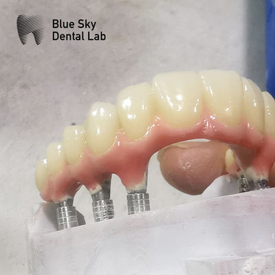 Beli Bentuk Alam Kasus Implantasi Lengkungan Penuh Kasus Implantasi Gigi Permukaan Lancar online manufacture