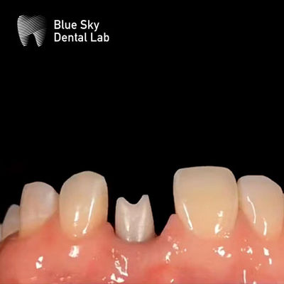 Beli Hipolergenik Implan Gigi Zirconia Abutment Biokompatibel online manufacture