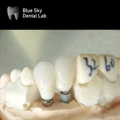 Beli Mahkota Tunggal Zirconia Abutment Hipolalergenik Implan Gigi Zirconia Abutment online manufacture