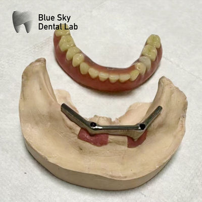Beli Implan Overdenture Titanium Bar Implan gigi dengan gigi palsu yang bisa dilepas online manufacture