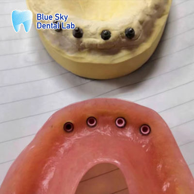 Beli Restorasi implan yang bisa dilepas lokator implan gigi palsu restorasi mulut penuh online manufacture
