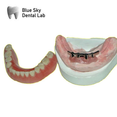 Beli Bar Titanium Gigi Yang Bisa Dihapus Untuk Gigi Gigi Blue Sky online manufacture