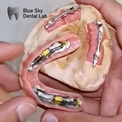 Beli Blue Sky Implantasi Gigi Dengan Titanium Bar Untuk Prosthesis Yang Dapat Dihapus online manufacture