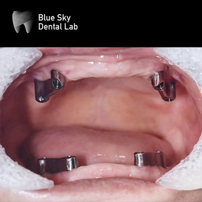 Beli Resin Gigi Gigi Titanium Bar Removable Blue Sky Sistem Implantasi online manufacture