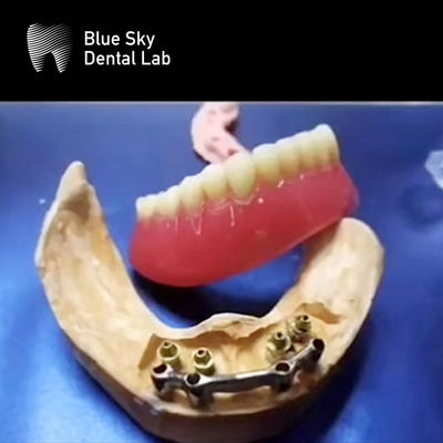 Beli Full Mouth Dental Titanium Bar Akurasi Restorasi Gigi yang Bisa Dihapus online manufacture