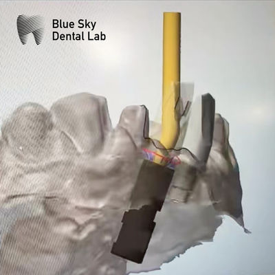 Beli Ti Base Screw Retained Abutment Implant Angular Screw Channel Abutment online manufacture