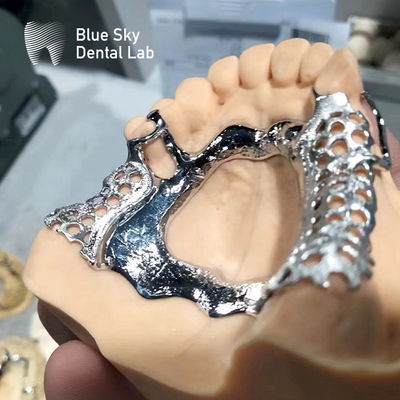 Beli Blue Sky Dental Frame Parsial Maxillary Denture Cast Metal Frame online manufacture
