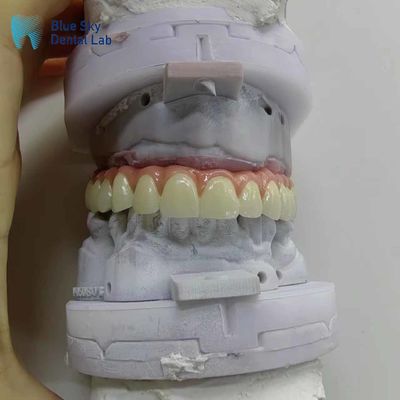 Nature Kasus Implan Gigi Buatan Kasus Implan Mulut Penuh Disesuaikan