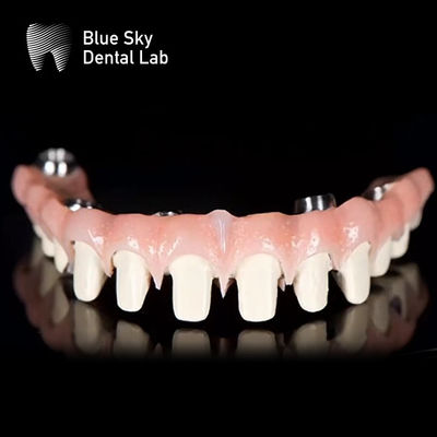 Sistem Implantasi Gigi Jembatan Malo Titanium Murni Blue Sky