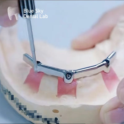 Precision Dental Titanium Bar With Precious Attachment Biokompatibel