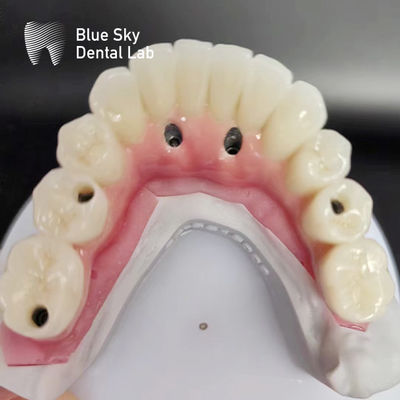 Kasus Implantasi Gigi Lengkung Lengkap Kompatibel Dengan Sistem Implantasi Berbagai