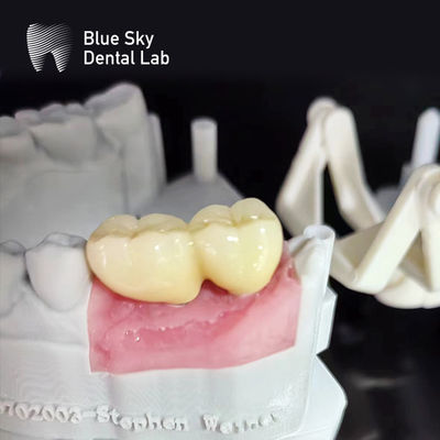 Kasus Implantasi Permukaan Lurus Sterilisasi Uap Kasus Implantasi Gigi