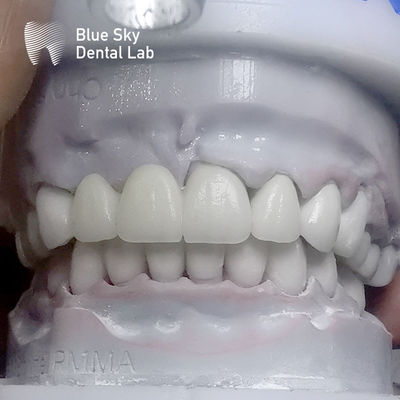 Gigi Zirconia berlapis persegi panjang multilayer sebelum glazing