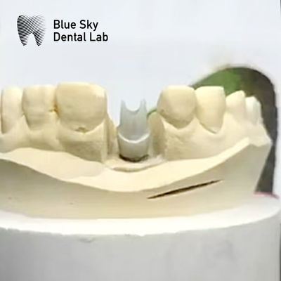 Estetika Zirconia Abutment Implant Biokompatibel Precision Milled