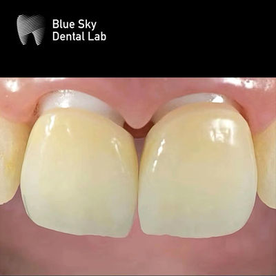 Layered Zirconia Implant Crown Zirconia Abutment Biokompatibel