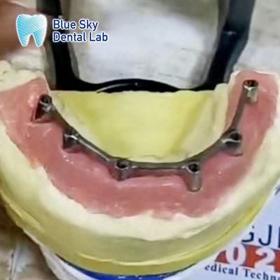Titanium Bar Overdenture Implant Removable Dengan Overdenture