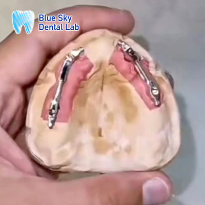 Implan Gigi Titanium Bar Segmentasi Implan Langit Biru