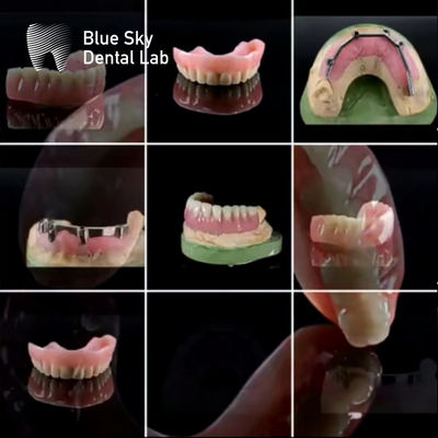 Universal Customized Dental Titanium Bar Dengan Gigi Akrilik