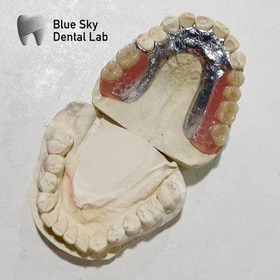 Pengaturan gigi palsu rangka logam resin gigi Rpd rangka logam