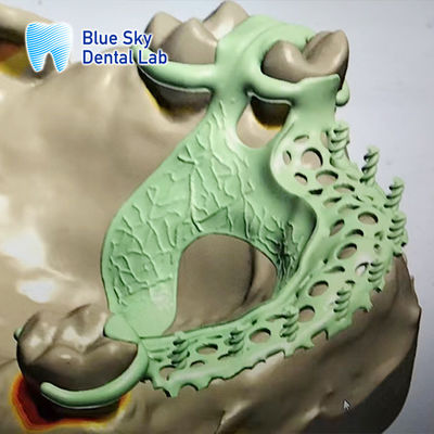 Denture Removable Rpd Frame Desain Denture Metal Parsial Frame Desain