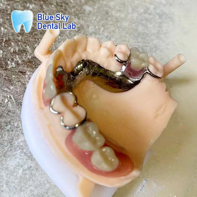 Rambut Akrilik Ringan Dental Parsial Dengan Bingkai Logam Dental yang terlihat realistis