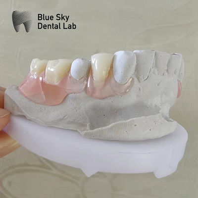Natural Smile Dental Valplast Dentures Fleksibel Valplast Bagian Denture Yang Bisa Dihapus