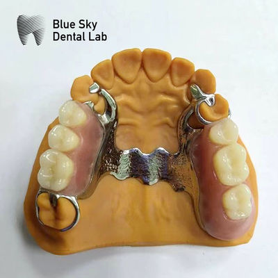 Dental Cast Parsial Denture Frame Parsial Denture Yang Tampak Nyata