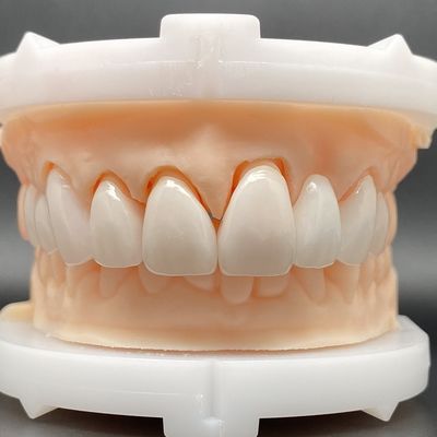 EMax Veneer Cases Passive Fitting Dalam Berbagai Warna Membuat Senyum Cantik Dengan Persiapan Gigi Minimal
