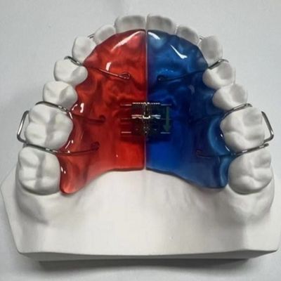 Stainless Steel Acrylic Screw Expander Pengobatan Ortodontik Bisa dilepas